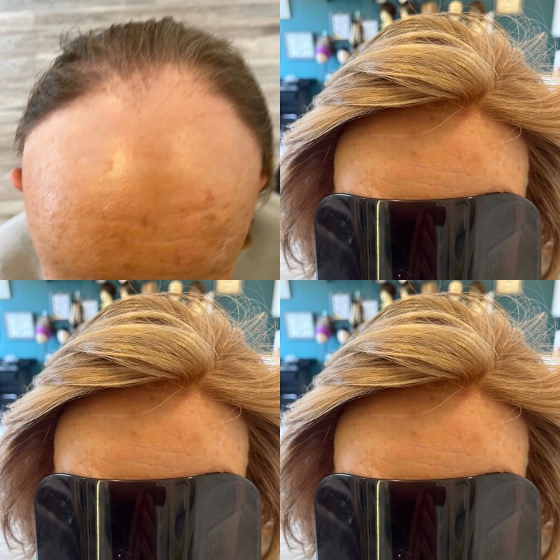 Frontal Fibrosing Alopecia (FFA)